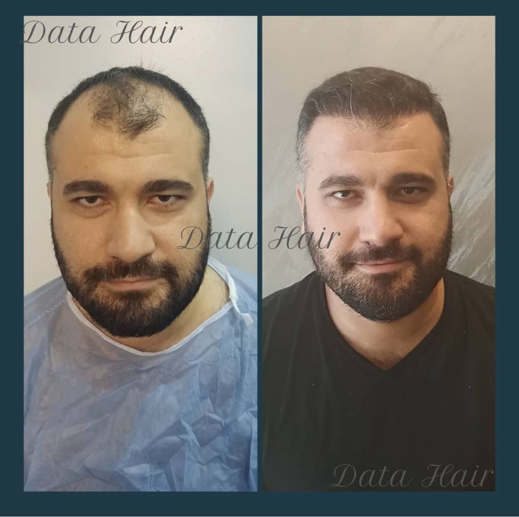 Data Hair Clinic & Eyyüp Tütüncü Saç Ekim Merkezi — Ankara, Turkey