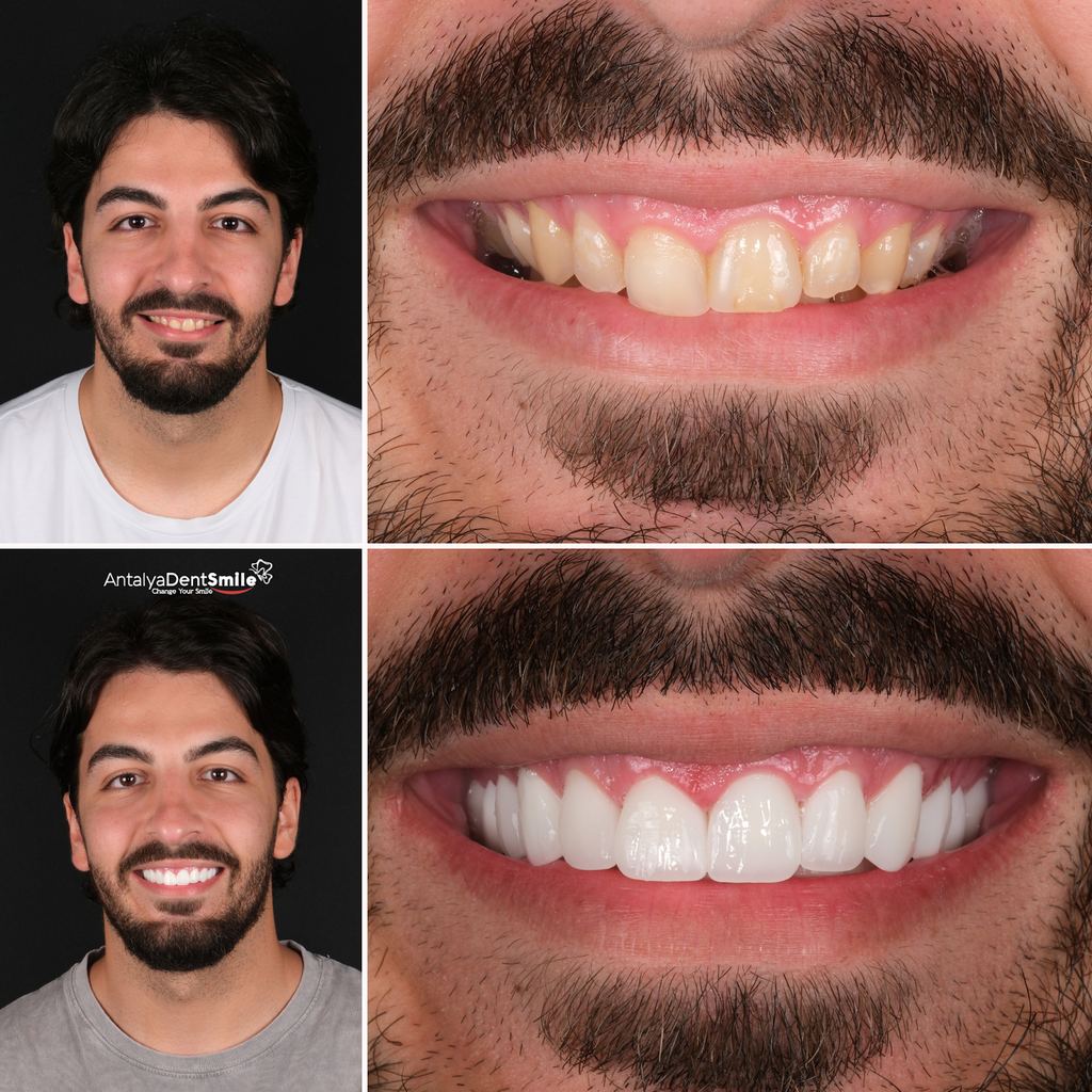 Antalya Dent Smile (Dental Implants, Crowns, Veneers & Invisalign) — Antalya, Turkey
