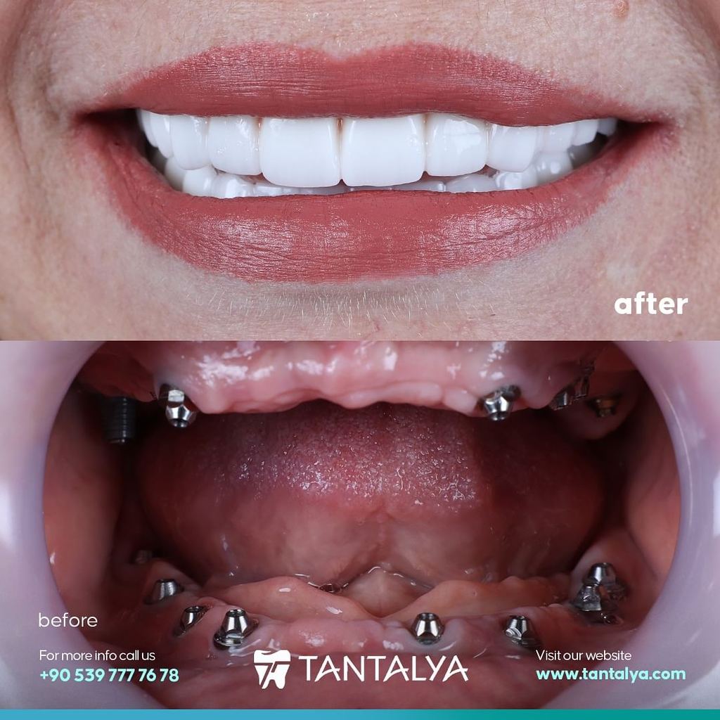 Tantalya Dental Clinic | Antalya Implant-Cosmetic Dentistry — Antalya, Turkey