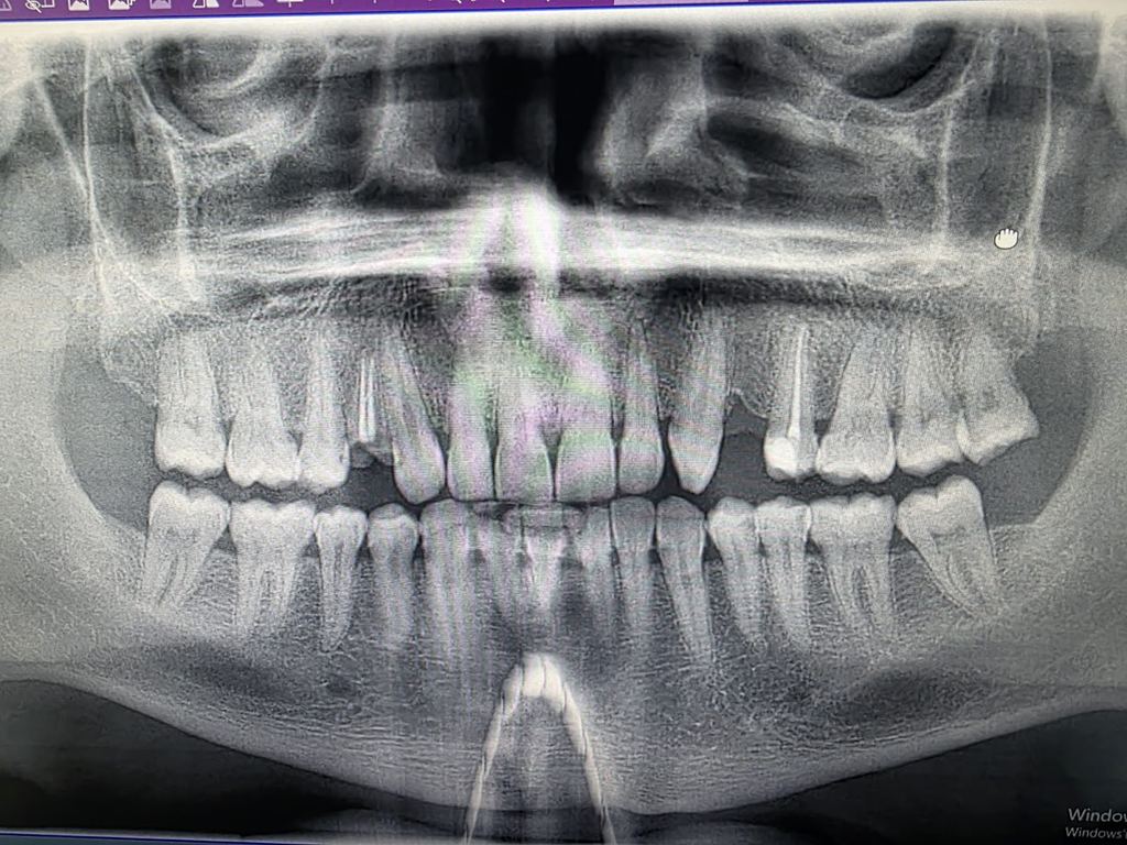 The best dental clinic in turkey | dental implants in turkey | All on 6 | All on 4 | Zirconium crowns | ALL ON X clinic — Istanbul, Turkey